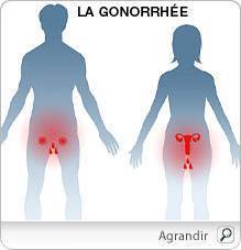 la gonorrhée